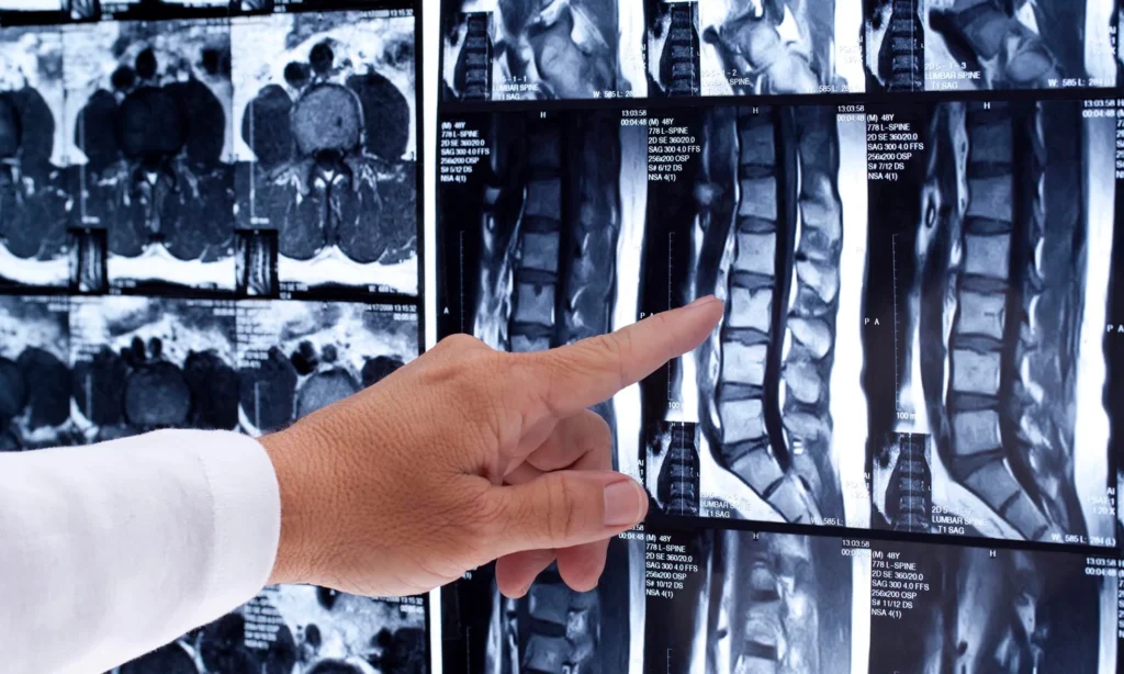 spinal-cord-injury-xray